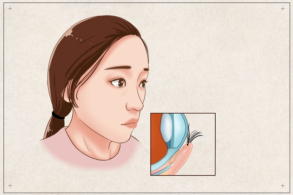 倒睫會自己好嗎？